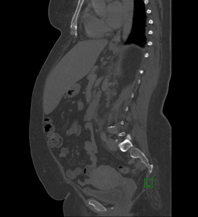 Chromophobe renal cell carcinoma (Radiopaedia 84239-99519 Sagittal bone window 49).jpg