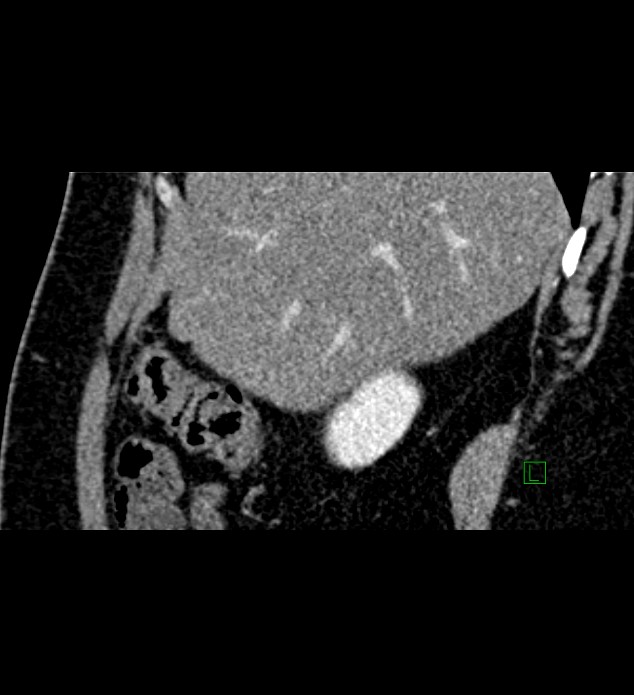 Chromophobe renal cell carcinoma (Radiopaedia 84286-99573 F 139).jpg