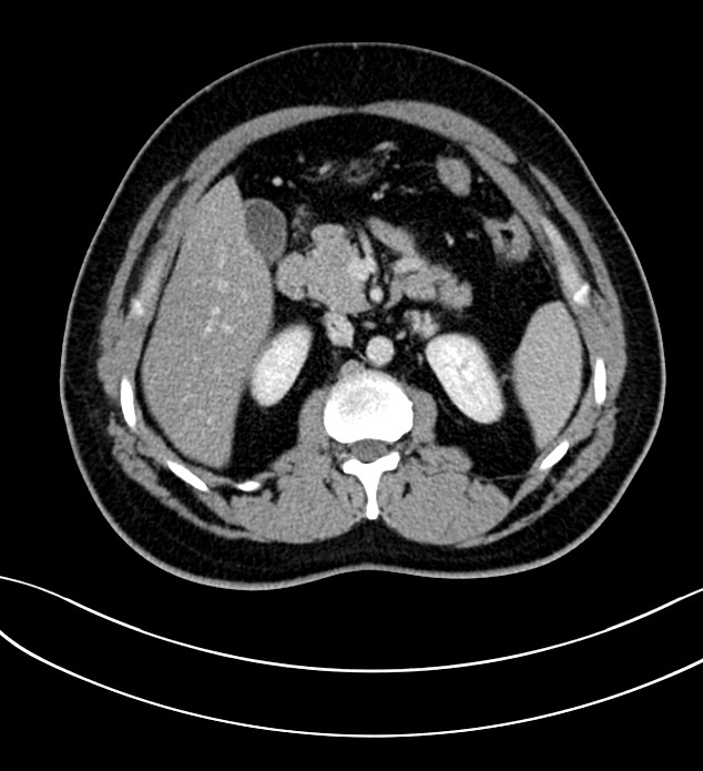 Chromophobe renal cell carcinoma (Radiopaedia 84286-99573 G 24).jpg