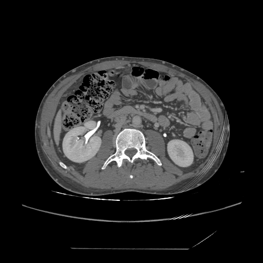 File:Chronic IVC thrombosis and resultant IVC filter malposition (Radiopaedia 81158-94800 A 101).jpg