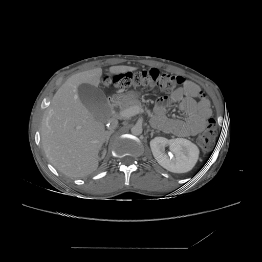 File:Chronic IVC thrombosis and resultant IVC filter malposition (Radiopaedia 81158-94800 A 61).jpg