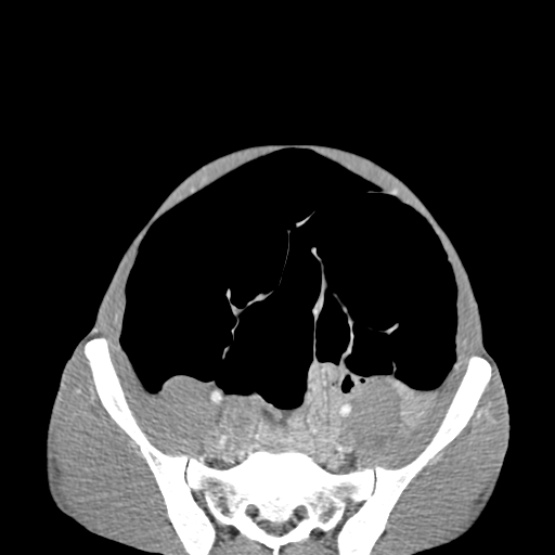 Chronic large bowel pseudo-obstruction (Radiopaedia 43181-46492 A 131).jpg