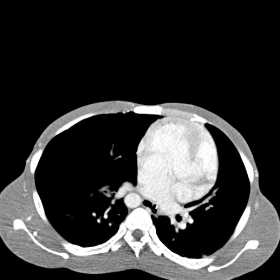 Chronic large bowel pseudo-obstruction (Radiopaedia 43181-46492 A 16).jpg