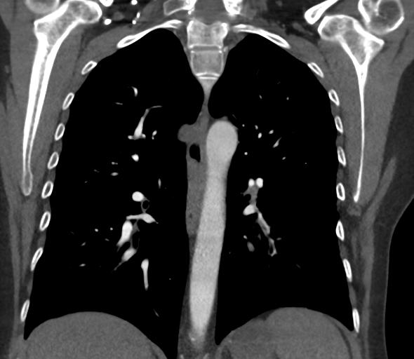File:Chronic pulmonary embolus (Radiopaedia 39129-41341 Coronal C+ CTPA 54).png
