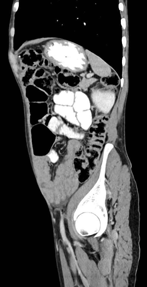 Chronic small bowel volvulus (Radiopaedia 75224-86322 C 40).jpg