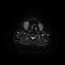 Chronic submandibular sialadenitis (Radiopaedia 61852-69885 Axial DWI 48).jpg