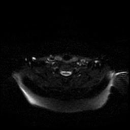 Chronic submandibular sialadenitis (Radiopaedia 61852-69885 Axial DWI 53).jpg