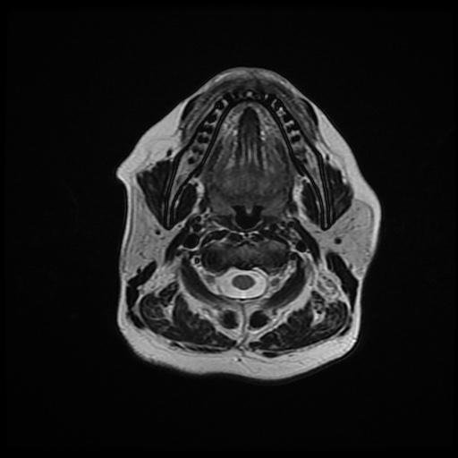File:Chronic submandibular sialadenitis (Radiopaedia 61852-69885 Axial T2 11).jpg