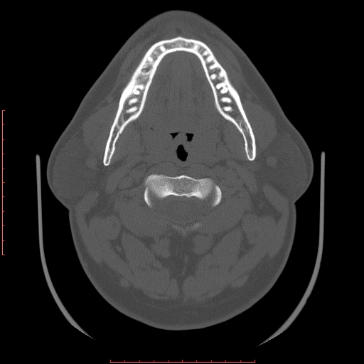 File:Chronic submandibular sialolithiasis (Radiopaedia 69817-79814 Axial bone window 48).jpg