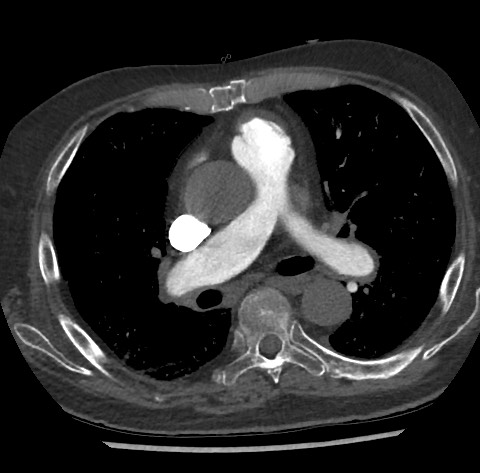 Chronic thromboembolic pulmonary disease (Radiopaedia 90694-108119 Axial C+ CTPA 47).jpg