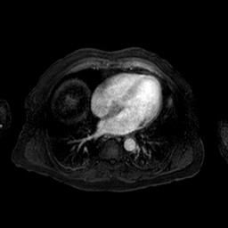 Cirrhosis and hepatocellular carcinoma in the setting of hemochromatosis (Radiopaedia 75394-86594 Axial T1 C+ fat sat 168).jpg