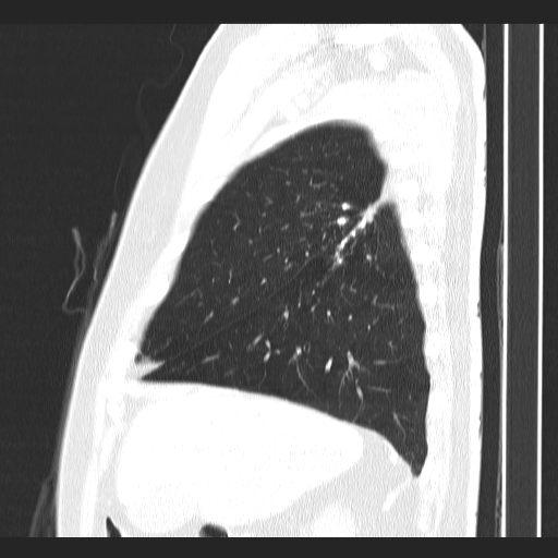 Classic complicated silicosis (Radiopaedia 49720-54961 Sagittal lung window 50).jpg