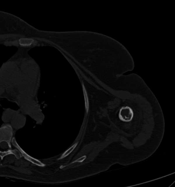 Clear cell chondrosarcoma - humerus (Radiopaedia 63104-71612 Axial bone window 71).jpg