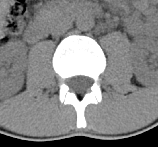 File:Clear cell meningoma - lumbar spine (Radiopaedia 60116-67691 Axial non-contrast 23).png