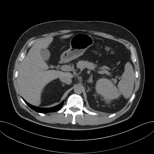 File:Clear cell renal cell carcinoma (Radiopaedia 61449-69393 Axial non-contrast 14).jpg