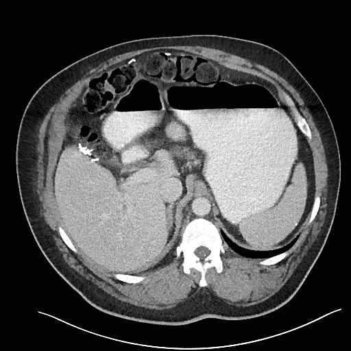 File:Closed loop obstruction - internal hernia into nephrectomy bed (Radiopaedia 59867-67320 A 36).jpg
