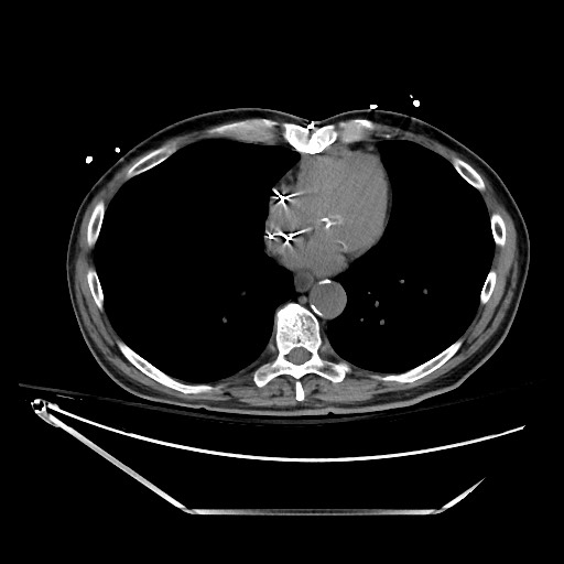 File:Closed loop obstruction due to adhesive band, resulting in small bowel ischemia and resection (Radiopaedia 83835-99023 Axial non-contrast 10).jpg