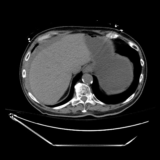 Closed loop obstruction due to adhesive band, resulting in small bowel ischemia and resection (Radiopaedia 83835-99023 Axial non-contrast 30).jpg