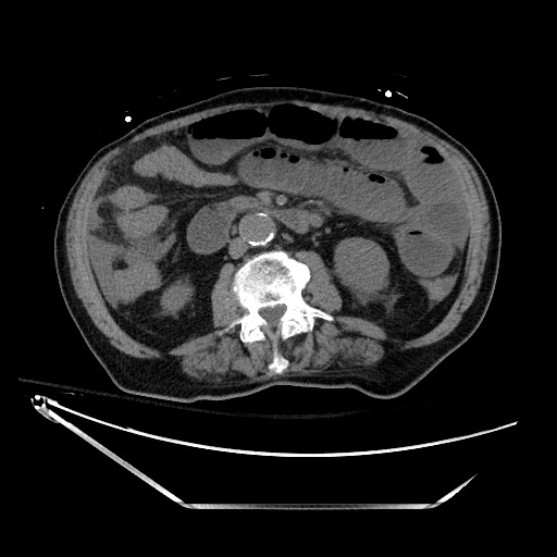 File:Closed loop obstruction due to adhesive band, resulting in small bowel ischemia and resection (Radiopaedia 83835-99023 Axial non-contrast 74).jpg