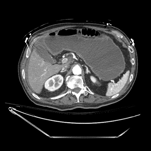 File:Closed loop obstruction due to adhesive band, resulting in small bowel ischemia and resection (Radiopaedia 83835-99023 B 44).jpg