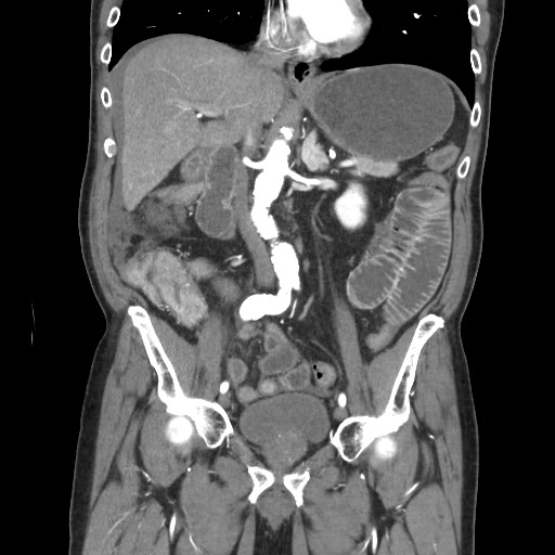 File:Closed loop obstruction due to adhesive band, resulting in small bowel ischemia and resection (Radiopaedia 83835-99023 C 63).jpg