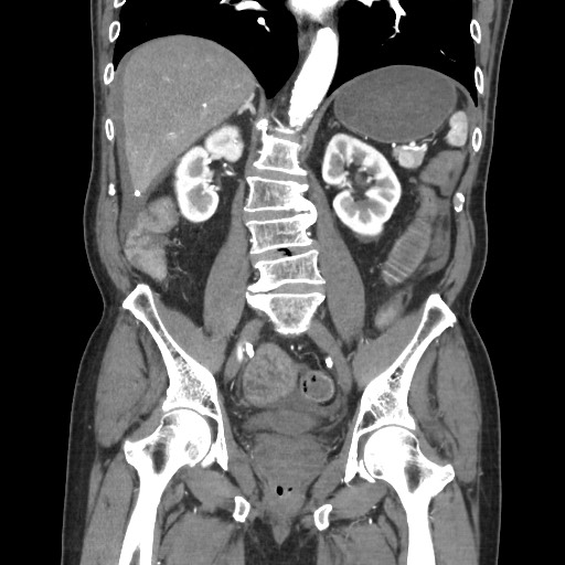 File:Closed loop obstruction due to adhesive band, resulting in small bowel ischemia and resection (Radiopaedia 83835-99023 C 77).jpg
