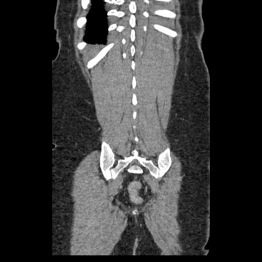 Closed loop small bowel obstruction (Radiopaedia 65403-74451 B 91).jpg