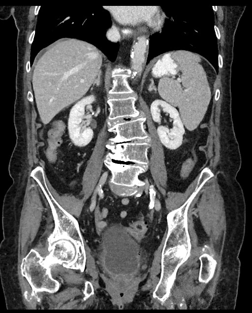 Closed loop small bowel obstruction - adhesions (Radiopaedia 59269-66611 B 74).jpg