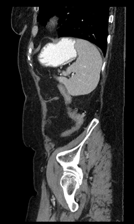 Closed loop small bowel obstruction - adhesions (Radiopaedia 59269-66611 C 24).jpg