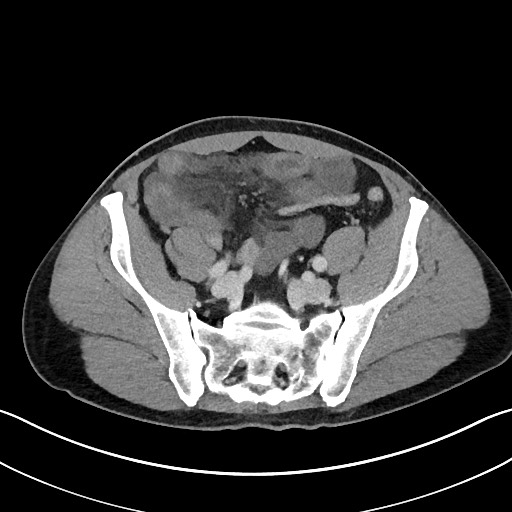 File:Closed loop small bowel obstruction - internal hernia (Radiopaedia 57806-64778 B 95).jpg