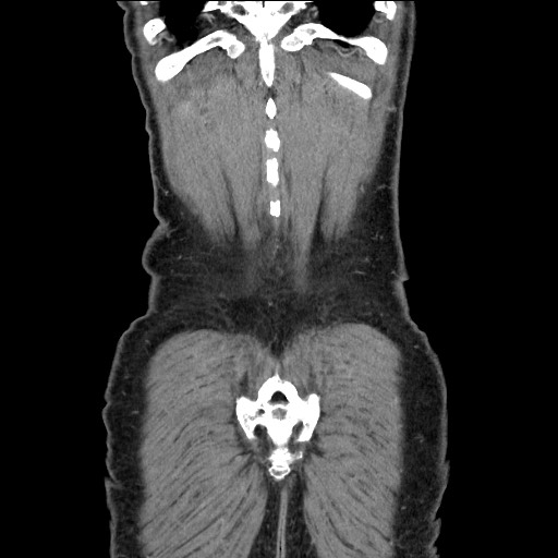 Closed loop small bowel obstruction - omental adhesion causing "internal hernia" (Radiopaedia 85129-100682 B 117).jpg