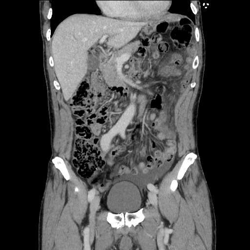 File:Closed loop small bowel obstruction - omental adhesion causing "internal hernia" (Radiopaedia 85129-100682 B 52).jpg