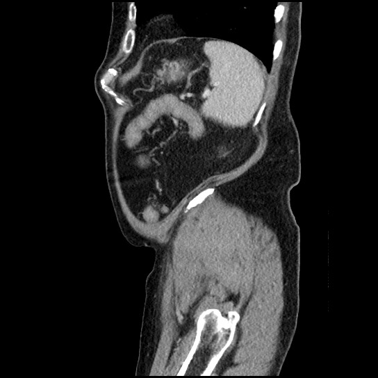 Closed loop small bowel obstruction due to adhesive band - U-shaped loop (Radiopaedia 83829-99012 C 14).jpg
