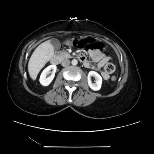 File:Closed loop small bowel obstruction due to adhesive bands - early and late images (Radiopaedia 83830-99014 A 58).jpg