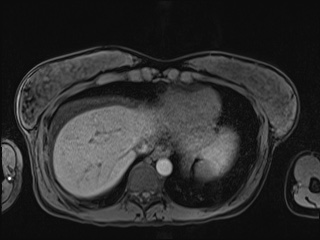Closed loop small bowel obstruction in pregnancy (MRI) (Radiopaedia 87637-104031 Axial T1 fat sat 14).jpg