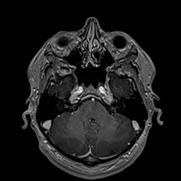 File:Cochlear incomplete partition type III associated with hypothalamic hamartoma (Radiopaedia 88756-105498 Axial T1 C+ 60).jpg