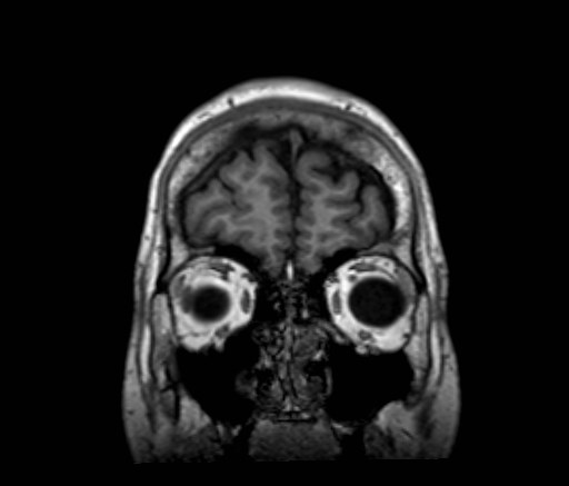 File:Cochlear incomplete partition type III associated with hypothalamic hamartoma (Radiopaedia 88756-105498 Coronal T1 55).jpg
