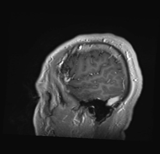 Cochlear incomplete partition type III associated with hypothalamic hamartoma (Radiopaedia 88756-105498 Sagittal T1 C+ 8).jpg