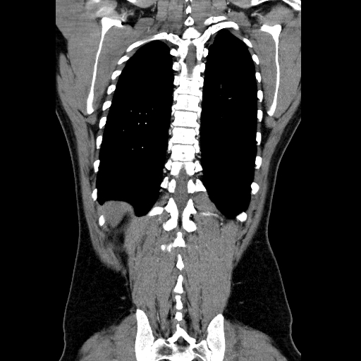 File:Codominant double aortic arch (Radiopaedia 56012-62637 B 39).jpg