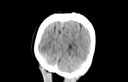 Colloid cyst (Radiopaedia 88663-105373 Coronal non-contrast 61).jpg