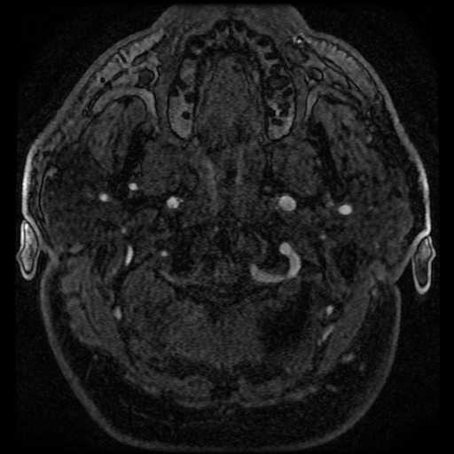 File:Colloid cyst with anterior communicating artery aneurysm (Radiopaedia 33901-35091 Axial MRA 18).jpg