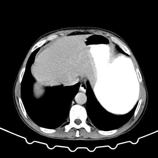 File:Colocolic intussusception due to large lipoma (Radiopaedia 68773-78482 A 13).jpg