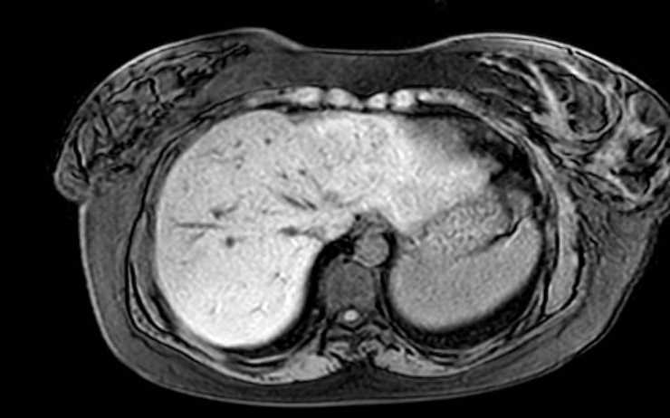 File:Colon adenocarcinoma with Krukenberg tumors, advanced pregnancy (Radiopaedia 67279-76645 A 73).jpg