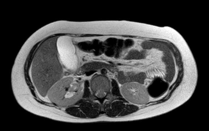 File:Colon adenocarcinoma with Krukenberg tumors, advanced pregnancy (Radiopaedia 67279-76645 Axial T2 51).jpg