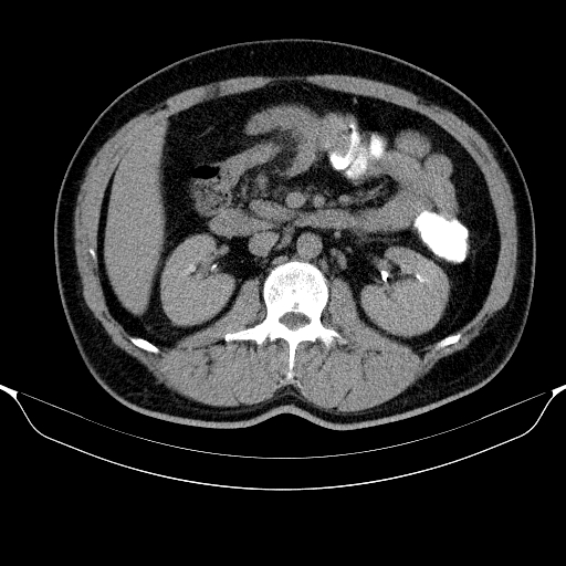 File:Colonic lipoma with colo-colic intussusception (Radiopaedia 58944-66200 Axial C+ rectal 24).jpg