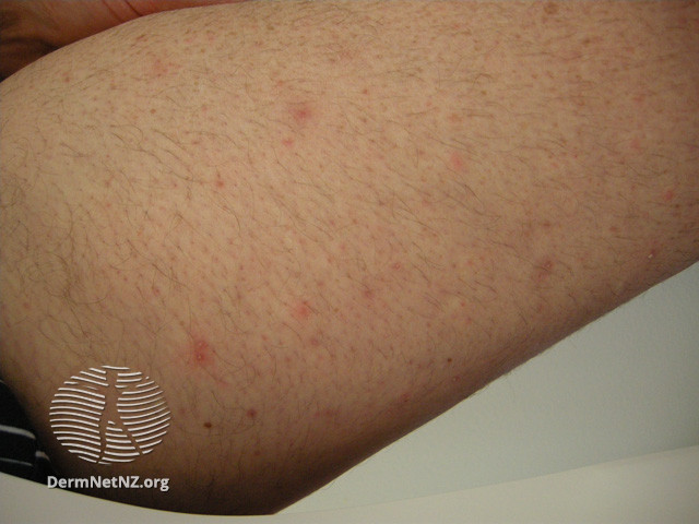 File:Folliculitis induced by sirolimus (DermNet NZ treatments-sirolimus-1).jpg