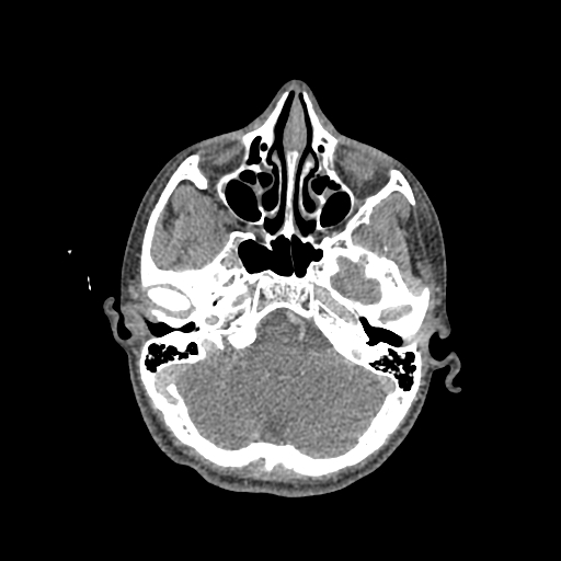 File:Nasal pyogenic granuloma (lobular capillary hemangioma) (Radiopaedia 85536-101244 C 89).jpg