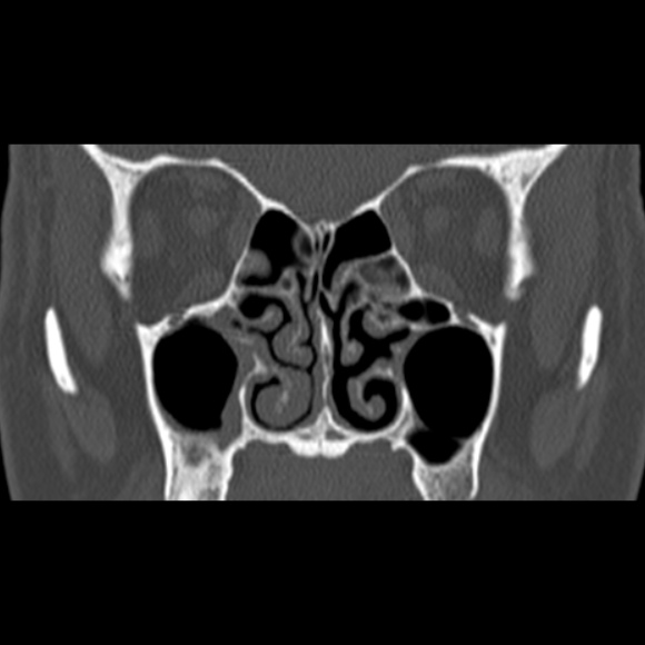 Nasal septal perforation (Radiopaedia 25030-25289 Coronal bone window 37).jpg