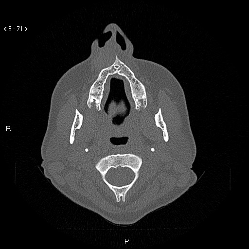 Nasolabial cyst (Radiopaedia 75125-86194 Axial bone window 32).jpg