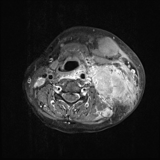 Nasopharyngeal carcinoma- T4,N3b (Radiopaedia 59376-67000 Axial T1 C+ fat sat 50).jpg
